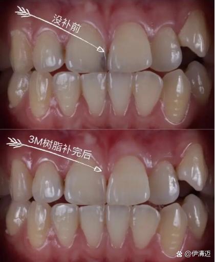 树脂补牙能维持多久游戏截图