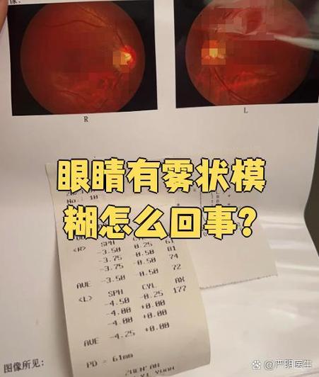 一只眼睛模糊有层雾挡